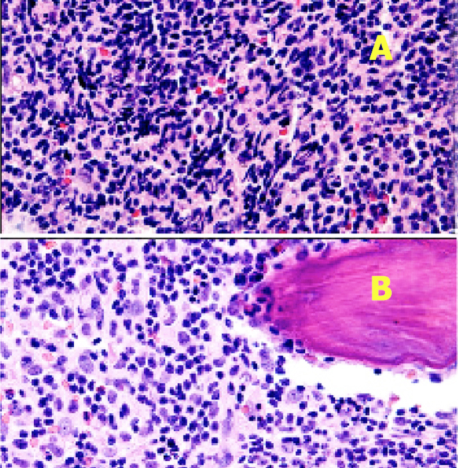 This image shows the pretreatment (A) and post-treatment (B) bone marrow of a patient with chronic lymphocytic leukemia who received CART-19 therapy.